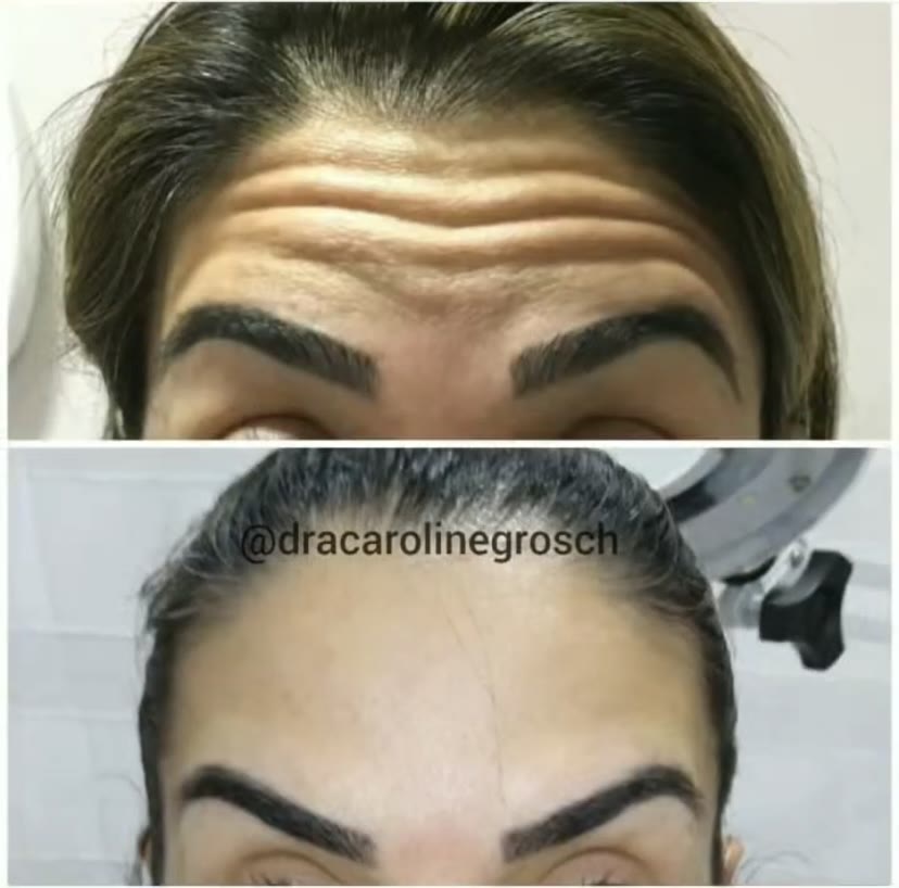 Antes e depois — botox na testa