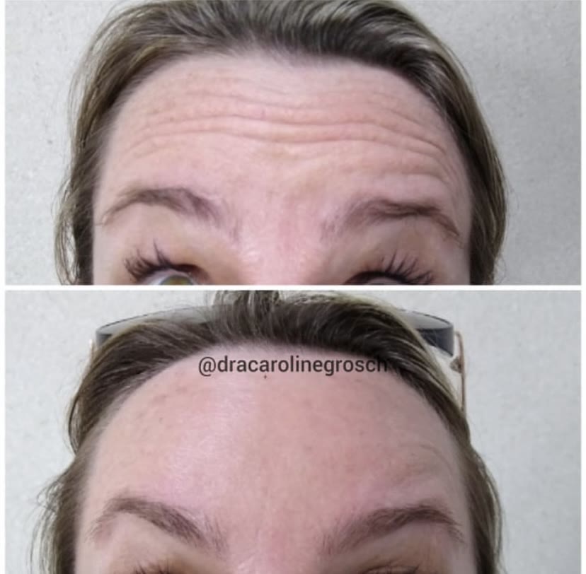 Antes e depois — botox na testa