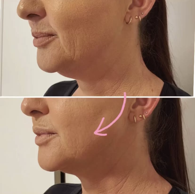 Antes e depois — lipo de papada