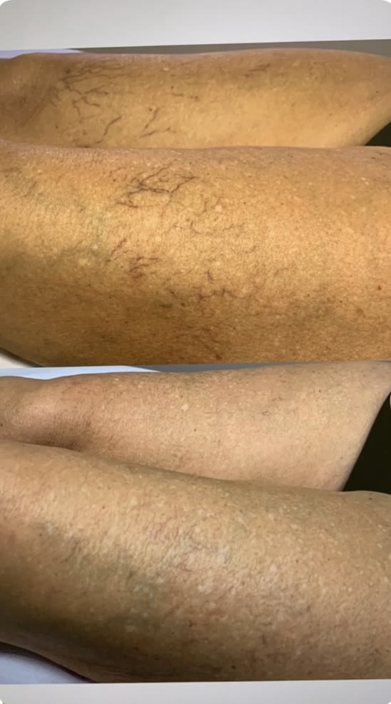 Antes e depois — secagem de vasinhos