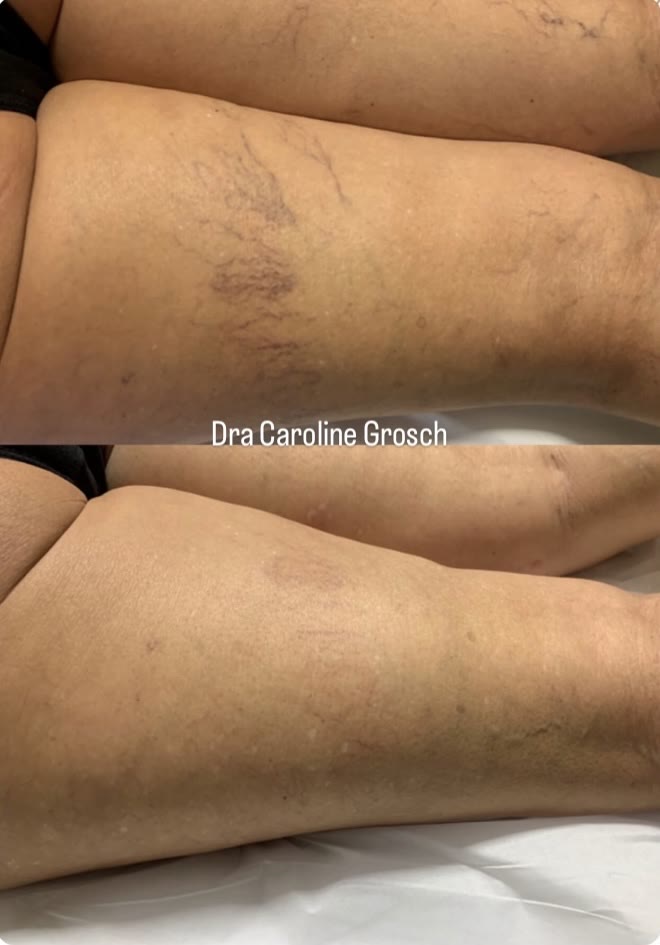 Antes e depois — secagem de vasinhos